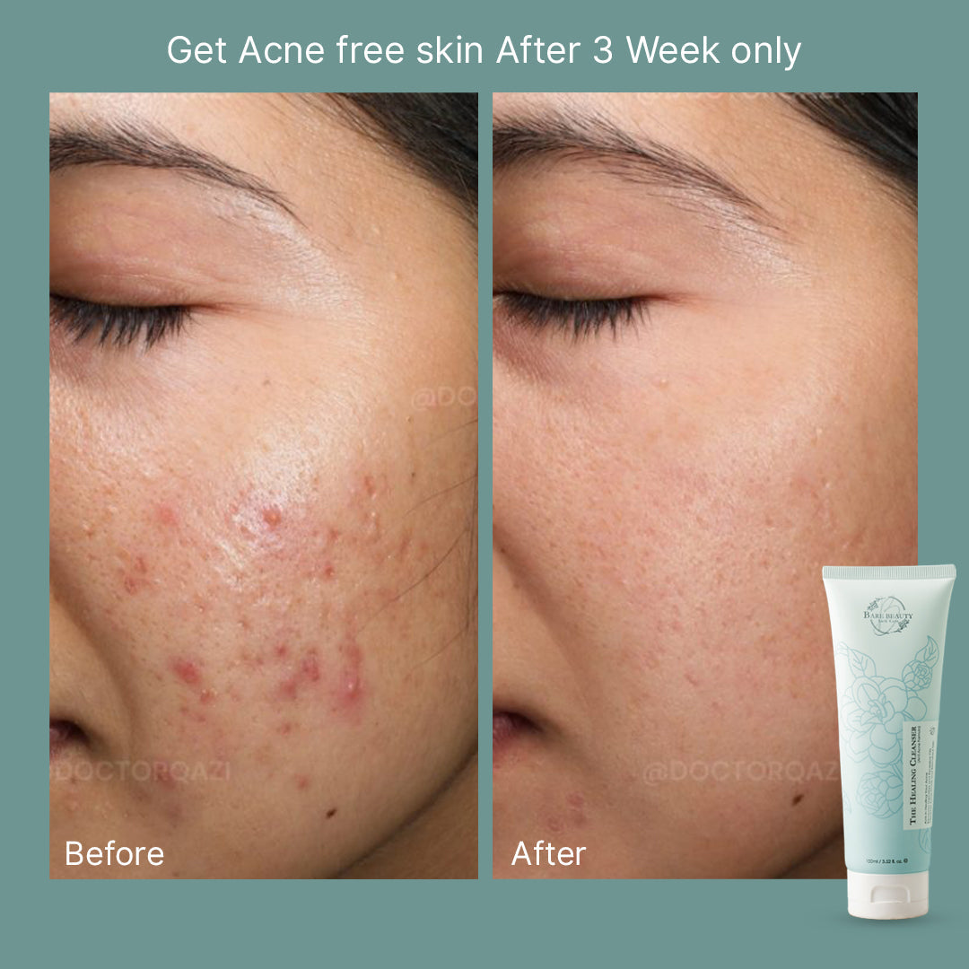 The Healing: Acne Cleanser